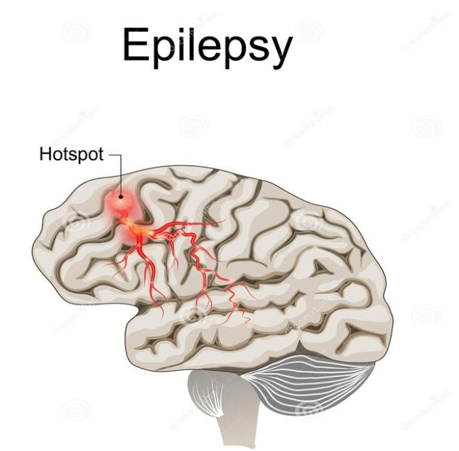 मिर्गी / दौरे