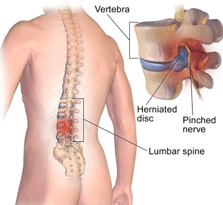 स्लिप डिस्क (डिस्क का खिसकना)